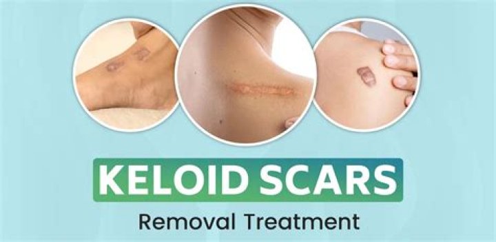 Don’t Keloid – Hollywood Life